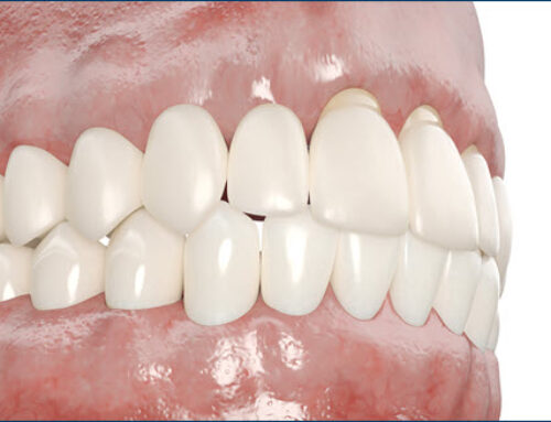 How to Prevent Gum Erosion