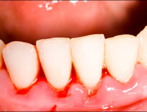 Gingivitis: Consequences and Prevention for Healthier Gums