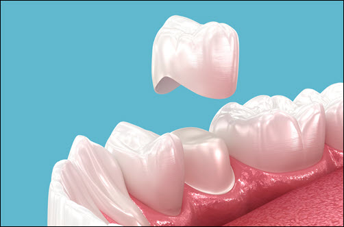 Damaged Teeth