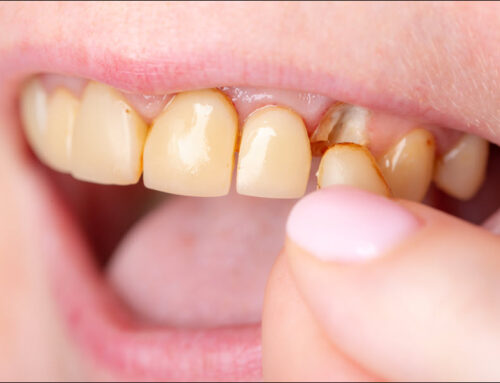 Restoring Cracked, Broken, or Discolored Teeth