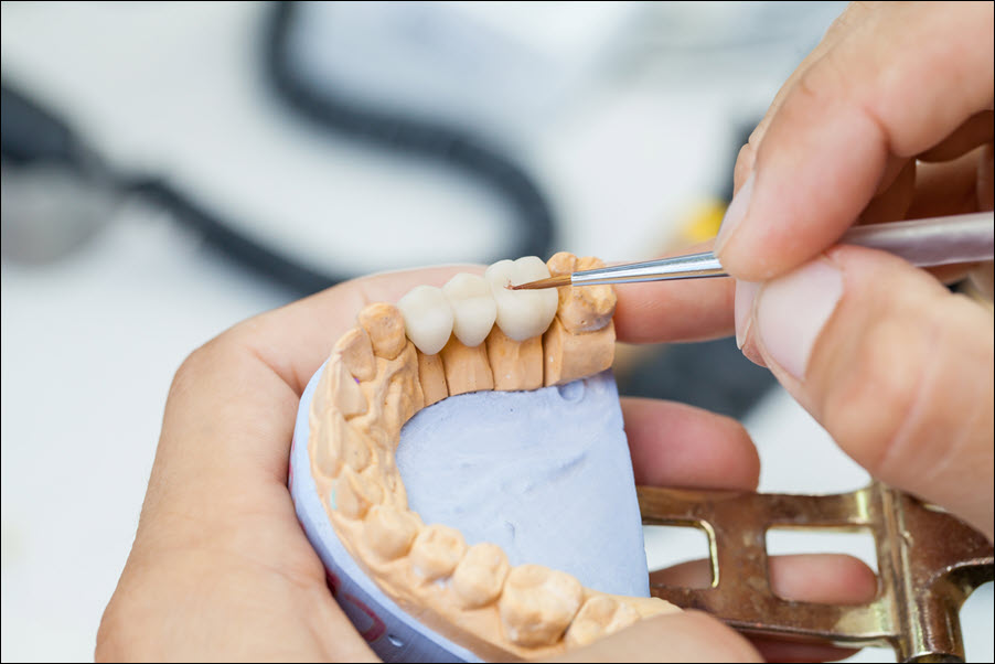 Dental Crowns
