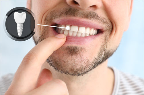 Dental Implants