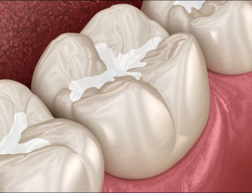 Dental Sealants Protect Teeth
